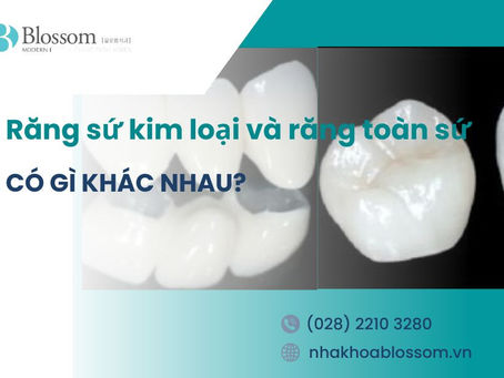 RĂNG SỨ KIM LOẠI VÀ RĂNG TOÀN SỨ: CÓ GÌ KHÁC NHAU?