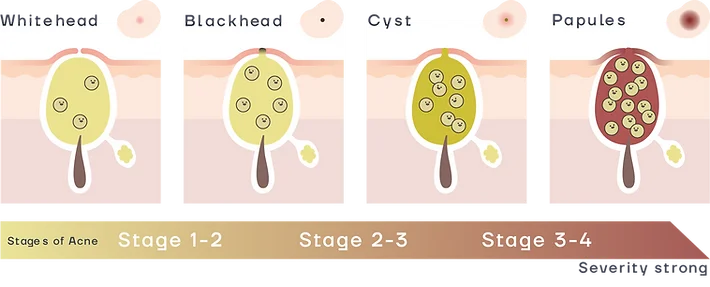 AcneStage.webp