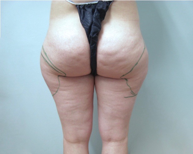 Liposculpture Hüfte Vorher