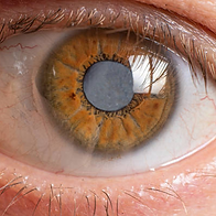 conjunctivitis