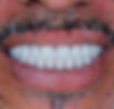 _MG_Protese 2 - editada.jpg
