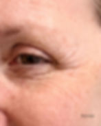 Before crows feet antiwrinkle