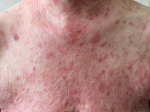 Mycosis Fungoides: มะเร็งต่อมน้ำเหลืองที่ผิวหนังที่วินิจฉัยยากที่สุด