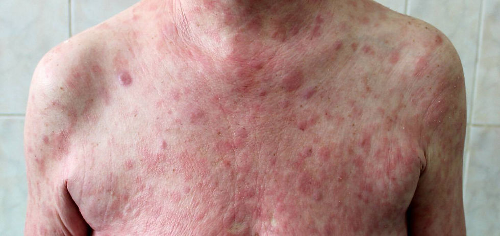 Mycosis Fungoides: มะเร็งต่อมน้ำเหลืองที่ผิวหนังที่วินิจฉัยยากที่สุด
