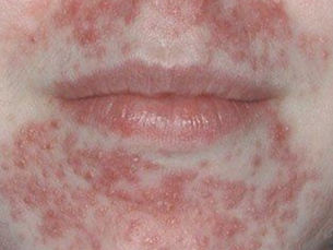 Perioral Dermatitis: ผื่นรอบปากที่มักถูกเข้าใจผิดว่าเป็นสิว