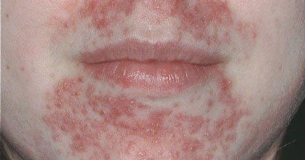 Perioral Dermatitis: ผื่นรอบปากที่มักถูกเข้าใจผิดว่าเป็นสิว