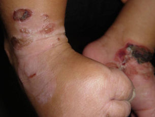 Epidermolysis Bullosa: โรคผิวหนังพุพองทางพันธุกรรมที่ต้องดูแลตลอดชีวิต
