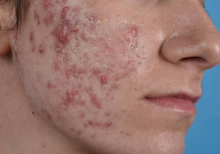 สิว (Acne): ประเภท สาเหตุ และวิธีรักษาสิวอย่างถูกต้อง