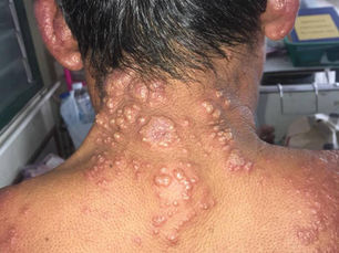 Sweet Syndrome: ผื่นแดงนูนเฉียบพลันที่ซ่อนโรคภายในไว้