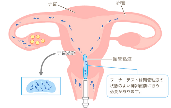 【修正済み】42：不妊症＞フーナーテスト.png