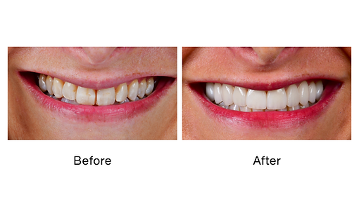 before-after-smile