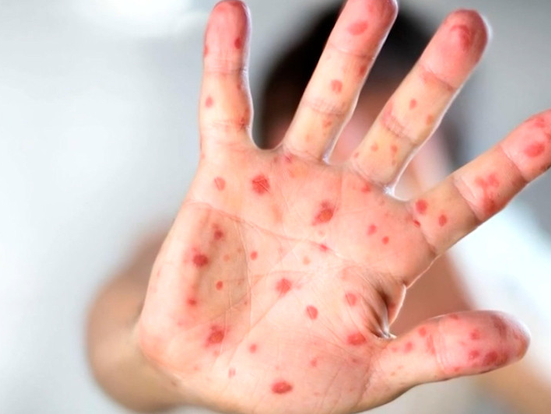 Autoridades refuerzan prevención de sarampión en escuelas de Chalco