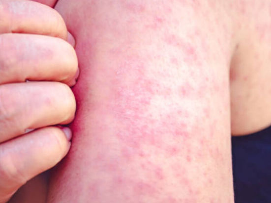 Epidemia de sarampión prende alertas en la OPS; activará medidas con México contra este brote