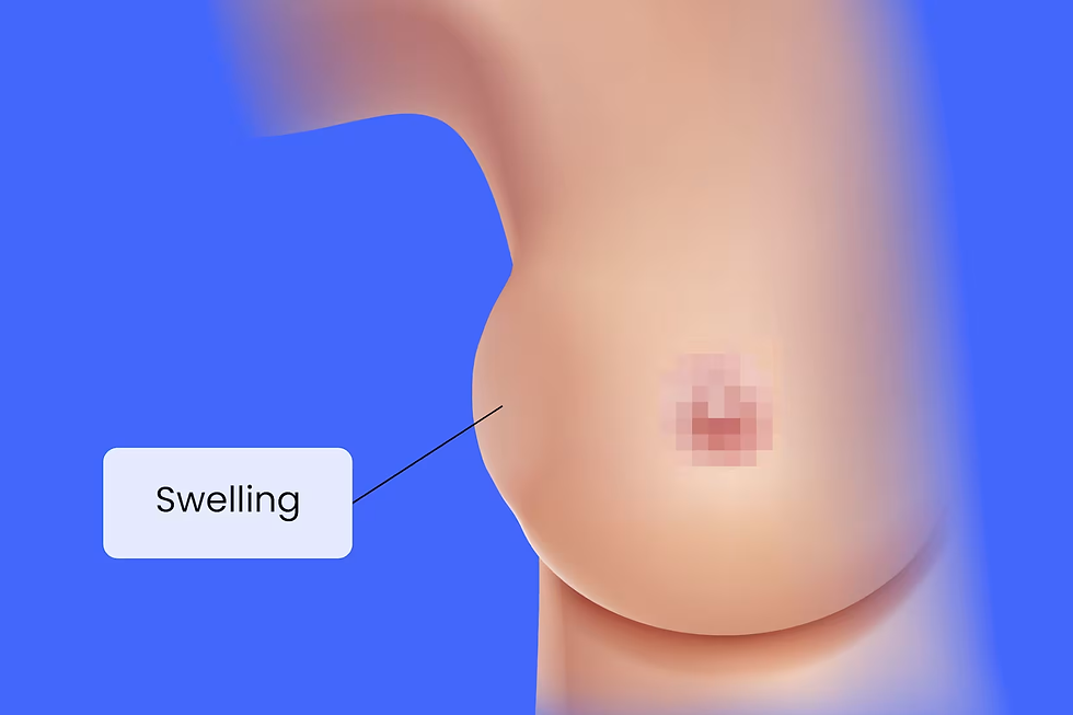 a photo-illustration of a womans breast with a lump protruding the left side of the body. a line pointing out to the blue background which reads "Swelling"