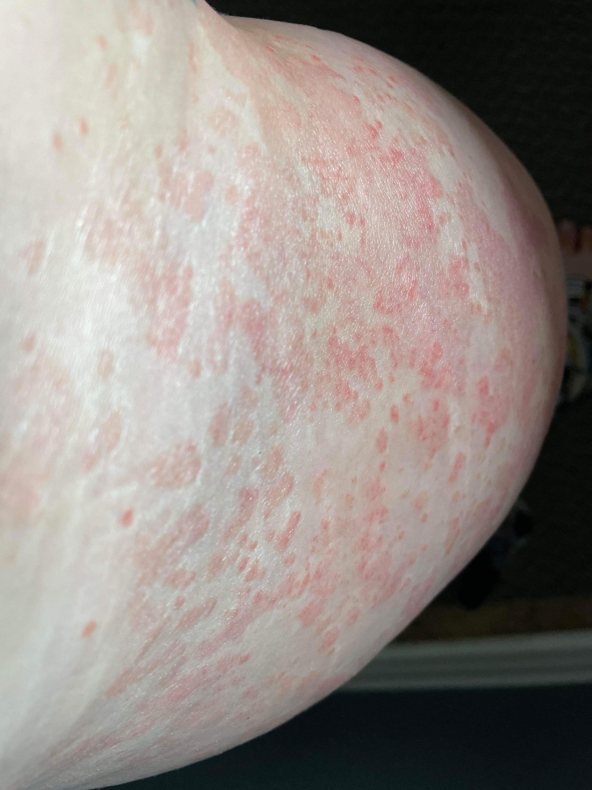Psoriasis cleared up with use of Hereward Farms Ravish Body Oil
