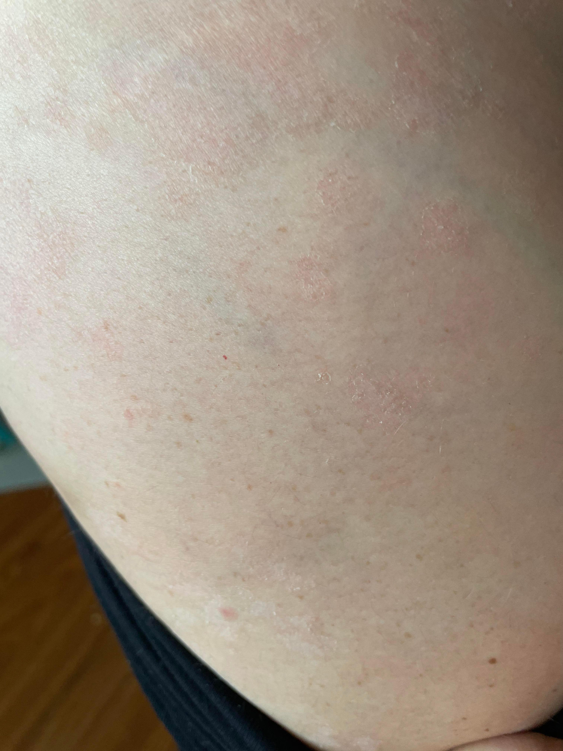 Psoriasis cleared up with use of Hereward Farms Ravish Body Oil