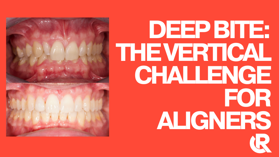 Deep bite: the vertical challenge for Aligners