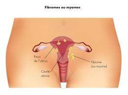 fibromes uterins