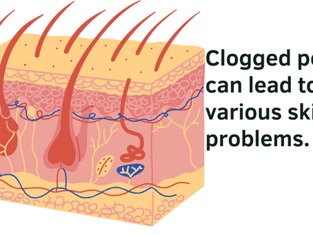 Clogged Pores: You Should Know