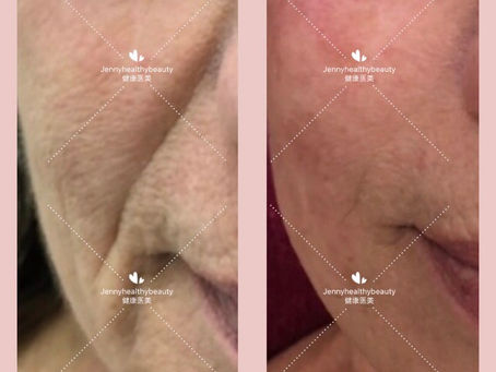 3D HIFU face lift