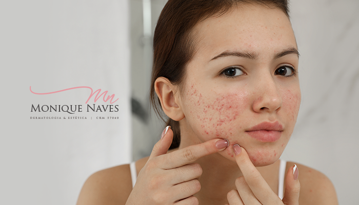 Acne na adolescência: 5 formas de lidar