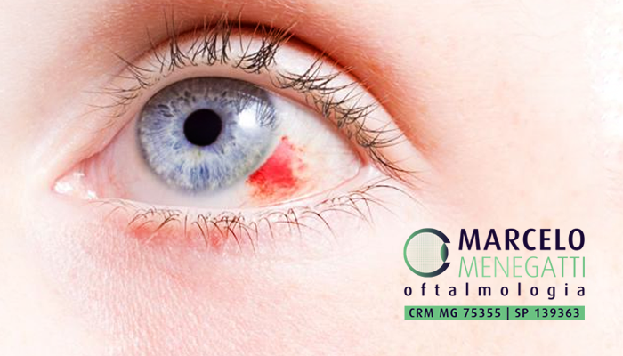 hemorragia subconjuntival