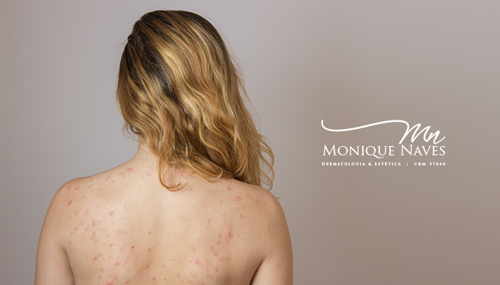 Rotina de cuidados para quem tem acne nas costas