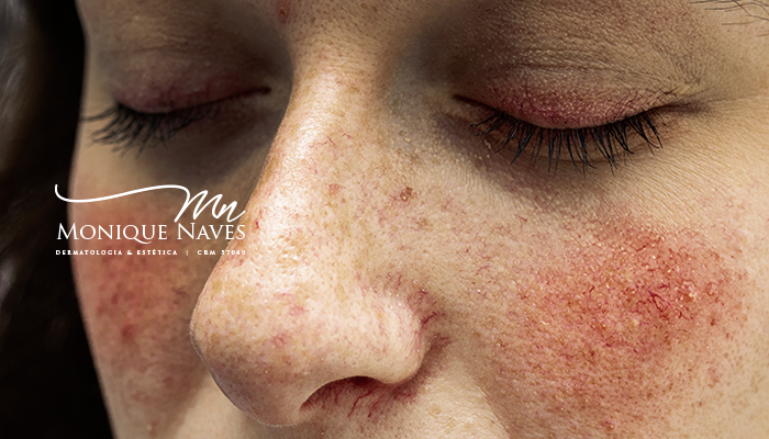O lúpus e a sua pele: qual é o papel do dermatologista?