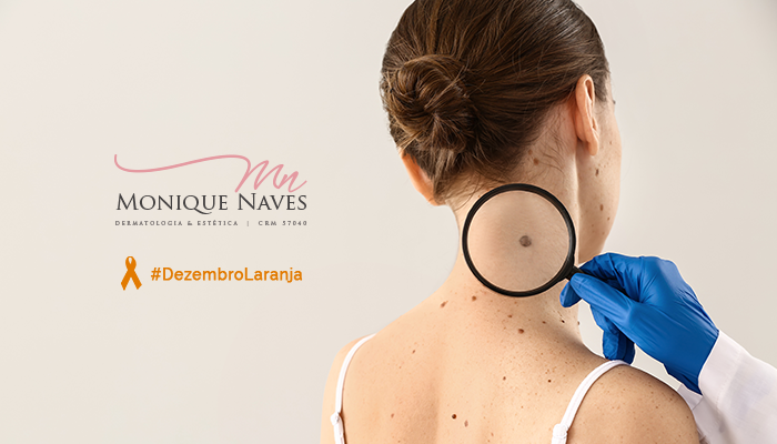 Qual é a CARA do câncer de pele? Conheça cada um dos tipos