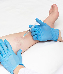 cirugia-escleroterapia-o-laser-son-algun