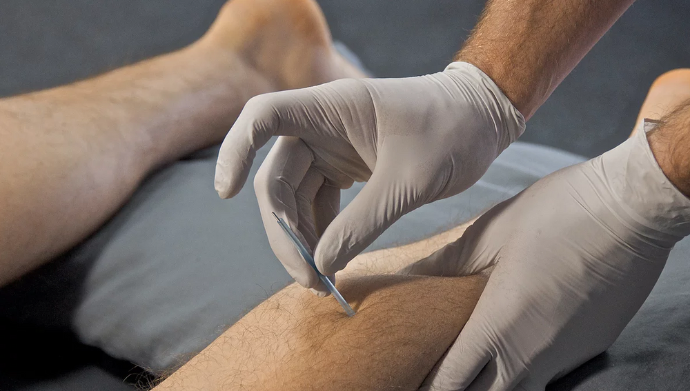 Dry Needling and it�s Applications in Podiatry