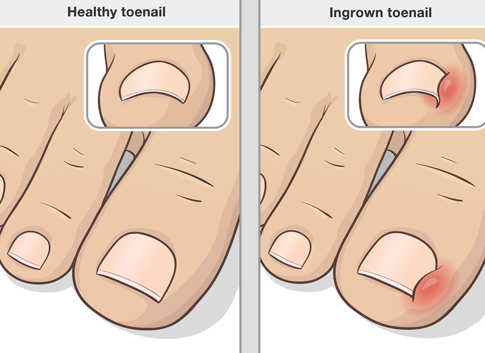 Ingrown Toenails