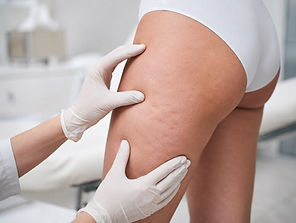 Avaliação dermatológica do relevo da pele da coxa em consultório — tratamento de celulite em Vitória ES