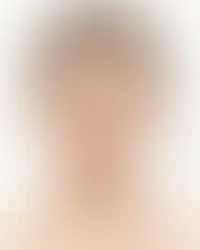 Rosto feminino de frente com dez regiões faciais rotuladas para preenchimento com ácido hialurônico