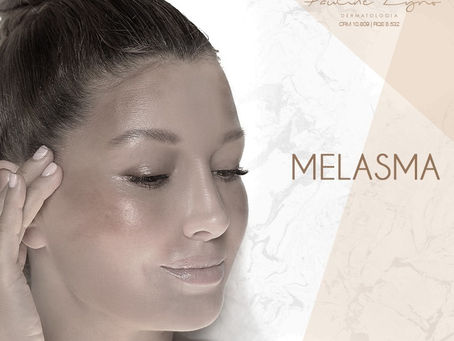Melasma