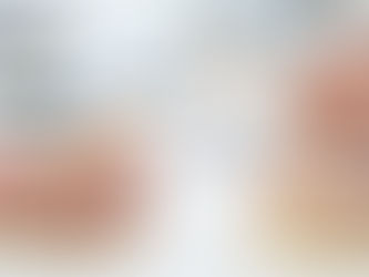 How Do All-on-4 Implants Compare to Snap-On Dentures in Houston TX