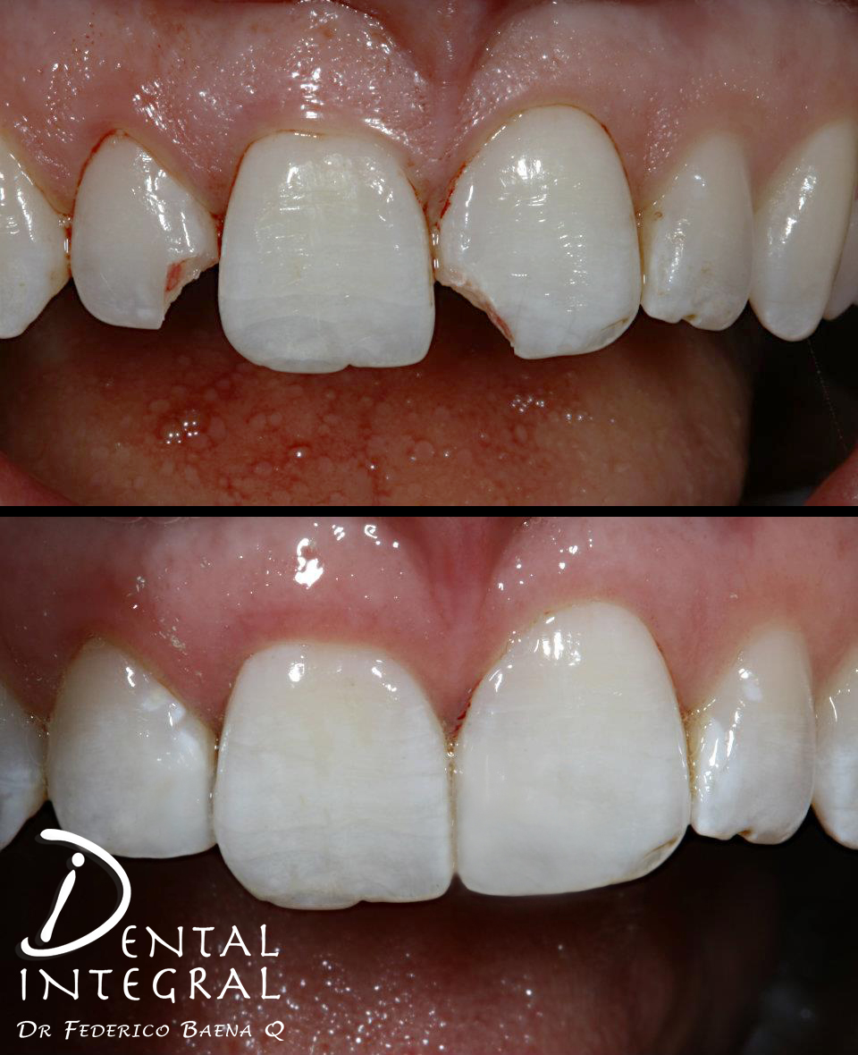 Resinas dentales Queretaro Dental Integral Baena Resinas dentales Queretaro Dental Integral Baena