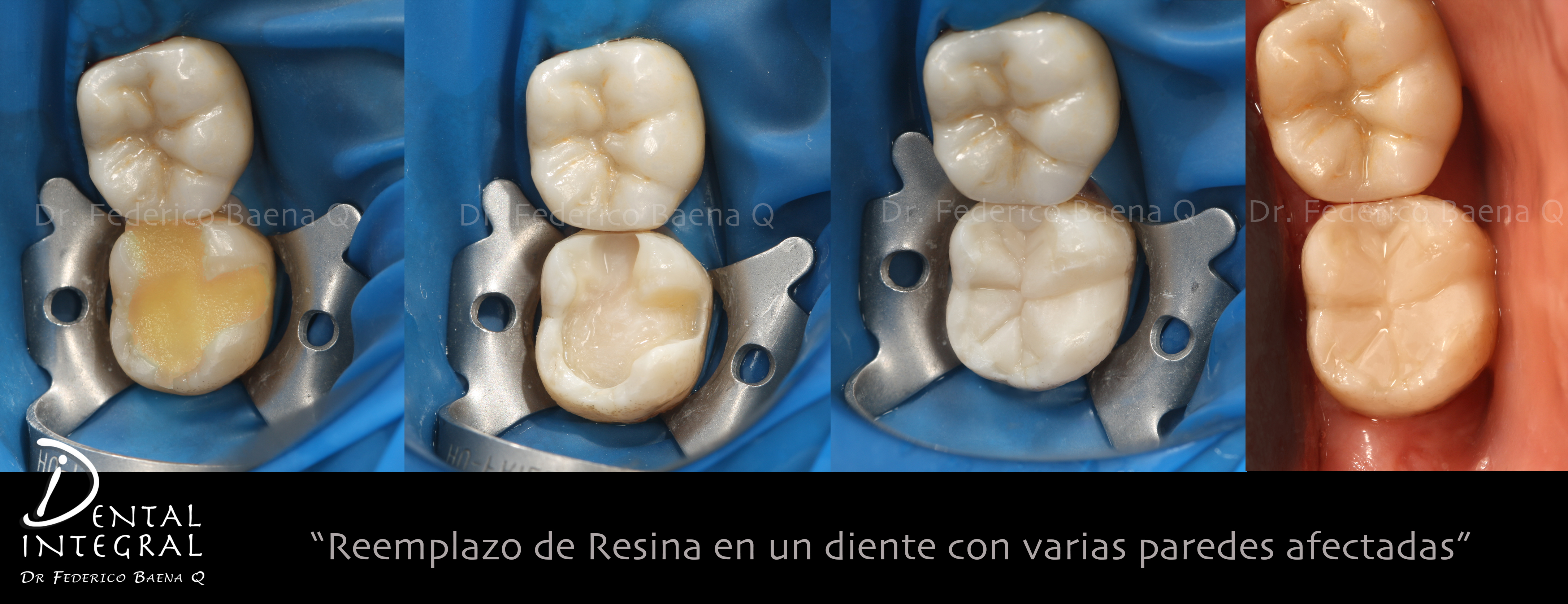 Resinas dentales Queretaro Dental Integral Baena Resinas dentales Queretaro Dental Integral Baena