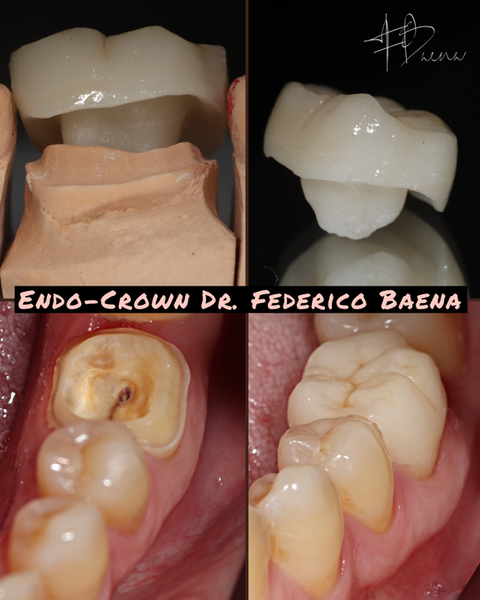Corona post endodoncia Doctores Baena, Querétaro