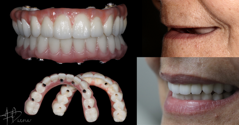 Dentaduras sobre implante Doctores Baena, Querétaro