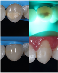 Retirando manchas dentales Querétaro, Doctores Baena