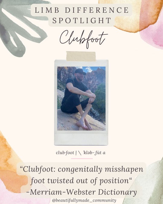 Clubfoot