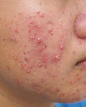 Acne