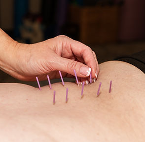 TP dry needling .jpg