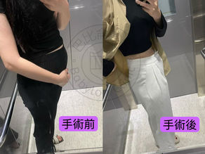 抽腰腹髖+自體脂肪隆乳/豐額