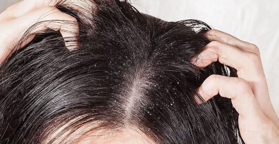 жирна шкіра голови, причини жирності волосся, догляд і як це контролювати