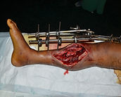 FRACTURE TREATMENT (2)