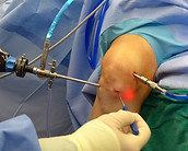 knee arthroscopy