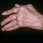 RHEUMATOID ARTHRITIS