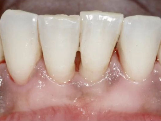 Gum Disease: Causes, Symptoms & Effective Treatment Options